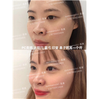 pc美眼1个月效果 