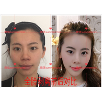 剥离微整|剥离微雕