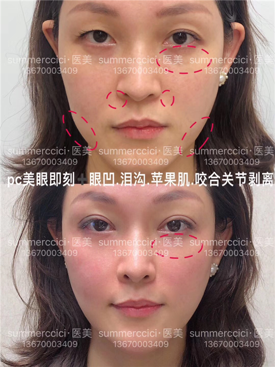 鼻基底剥离即刻效果 