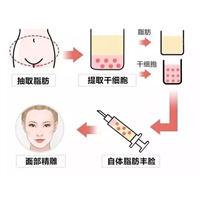 自体脂肪填充印第安纹效果怎么样？有什么风险？