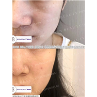印第安纹剥离多少钱？需要长期护理吗？