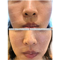 印第安纹是怎么形成的？印第安纹要怎么解决比较好呢？