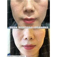 印第安纹怎么去除？这三种方法你会怎么选择？