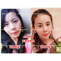 剥离微整|剥离微雕