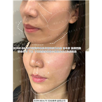 印第安纹按  摩手法管用么？和剥离相比怎么样？