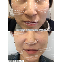 印第安纹苹果肌剥离1次效果 