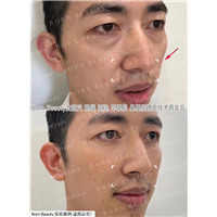 印第安纹怎么才能消除？是剥离好还是填充好？