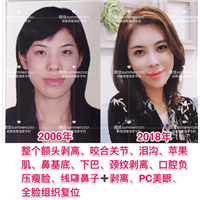 剥离微雕多少钱|剥离微整价格