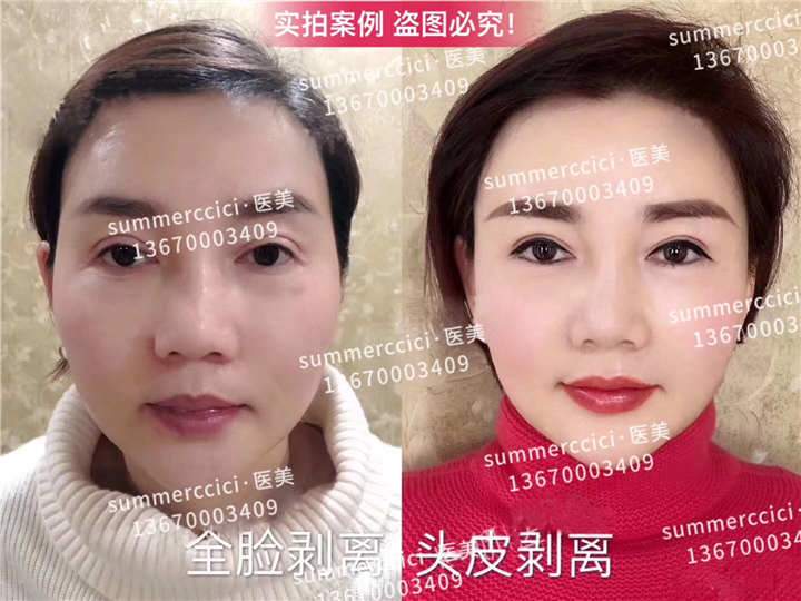 全脸头皮剥离 