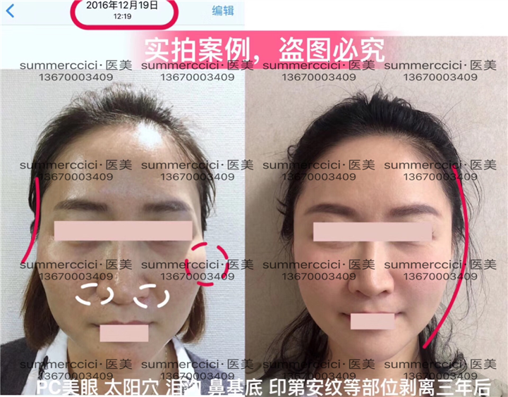 脸部多部位剥离三年后 