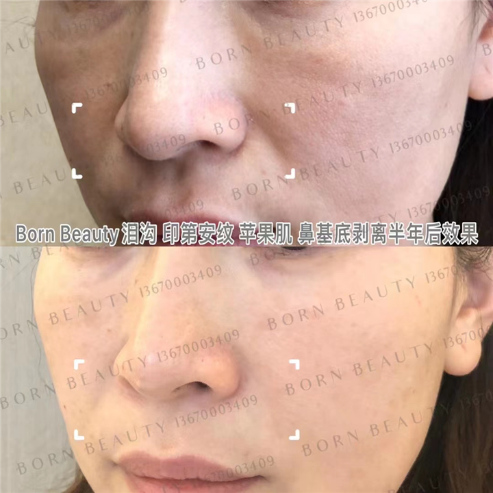什么运动能够减轻印第安纹？印第安纹怎么去除效果好？