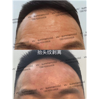 抬头纹剥离 
