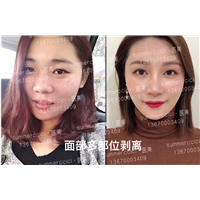 全脸剥离2年 