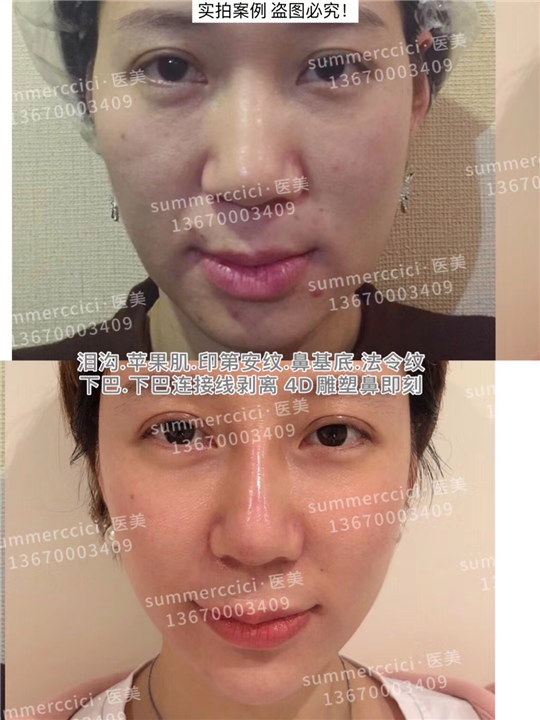 印第安纹苹果肌剥离 