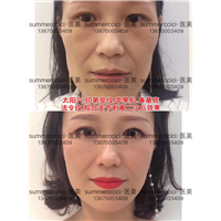 全脸剥离一年后 