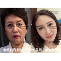 全脸剥离3年多 
