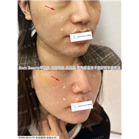 印第安纹是什么？印第安纹怎样才能有效的淡化？