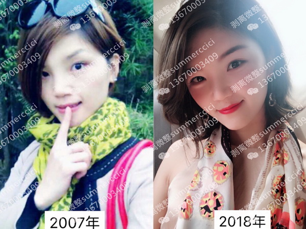 三维剥离|皮下剥离微雕