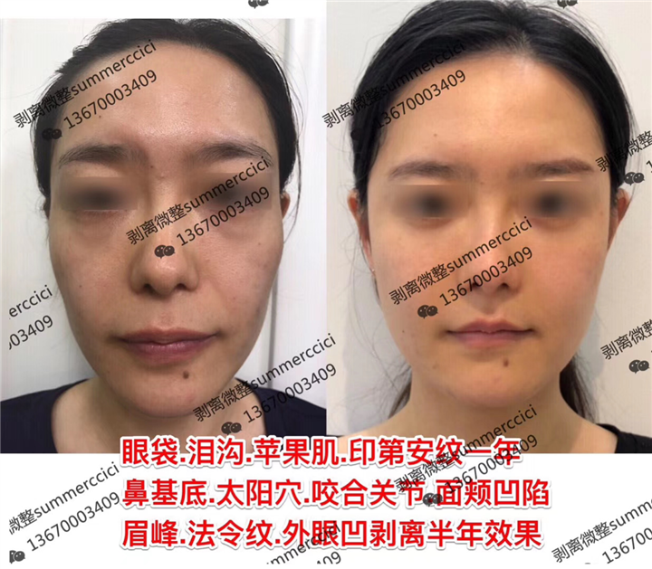 印第安纹剥离1年后效果 
