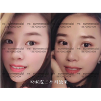 pc美眼3个月效果 