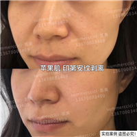印第安纹苹果肌剥离 