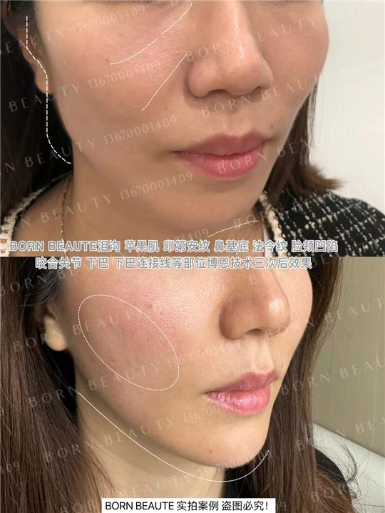 印第安纹一次医美可以维持几年？如何选择？