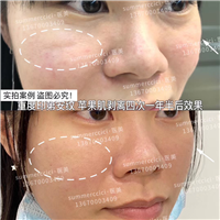 印第安纹剥离4次后效果 
