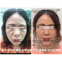 无痕祛眼袋加剥离泪沟2次后 