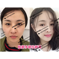 剥离微整价格|三维剥离