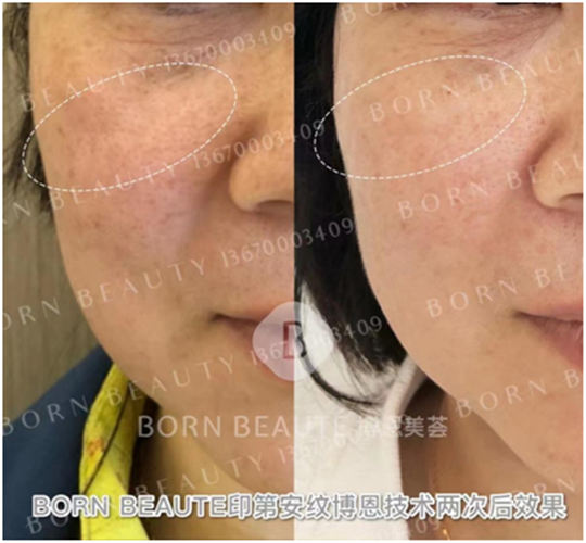 印第安纹为什么会加重？四个原因是印第安纹元凶