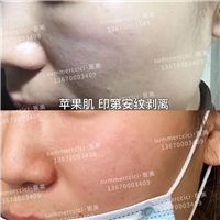 印第安纹苹果肌剥离 