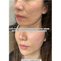 印第安纹怎么去除效果好？消除印第安纹需注意什么？