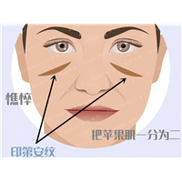 印第安纹打嗨体好还是玻尿酸好？彻底解决印第安纹这种方法才靠谱