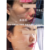 鼻基底剥离1年效果 