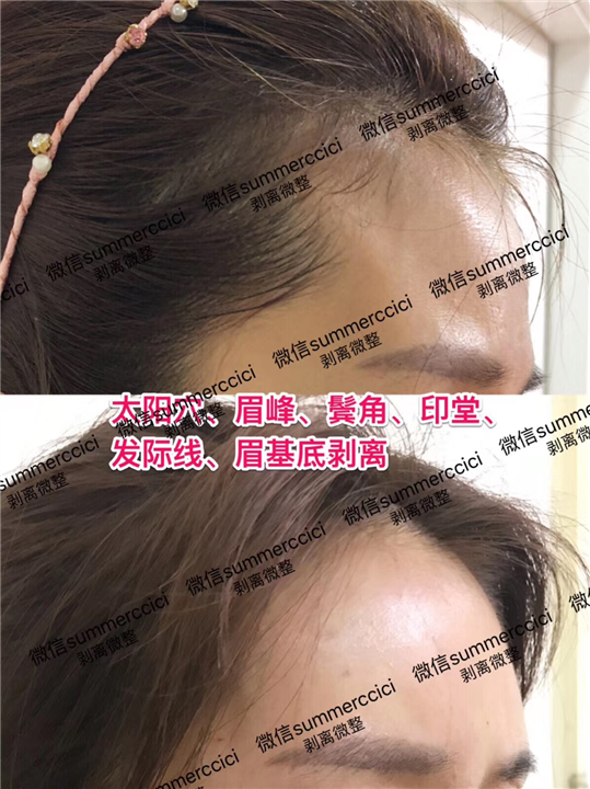 额头印堂剥离 