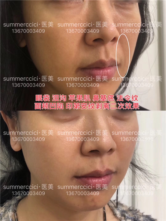 无痕祛眼袋加剥离泪沟4个月效果 