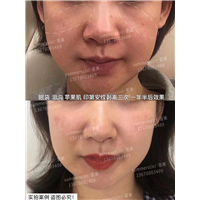 印第安纹苹果肌剥离一年半效果 