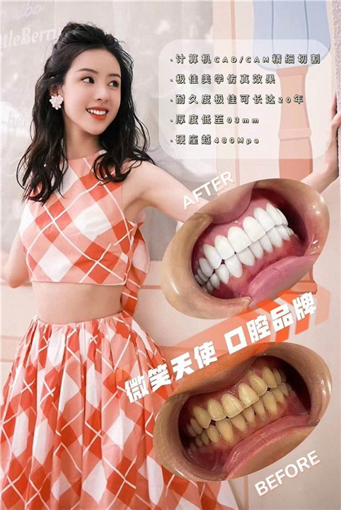 杭州牙贴面多少钱一颗