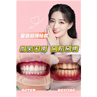 杭州做全瓷贴面哪家好