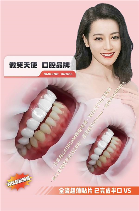 杭州牙贴面多少钱一颗