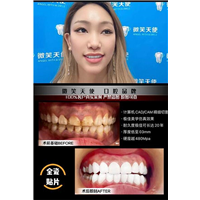 杭州哪里做牙贴面好