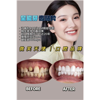 杭州牙贴面多少钱一颗