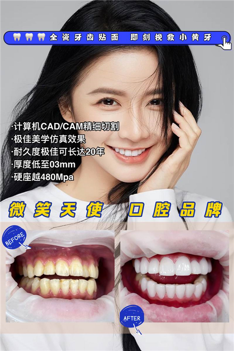 杭州做全瓷贴面哪家好