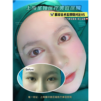 上海圣娅眼综合整形