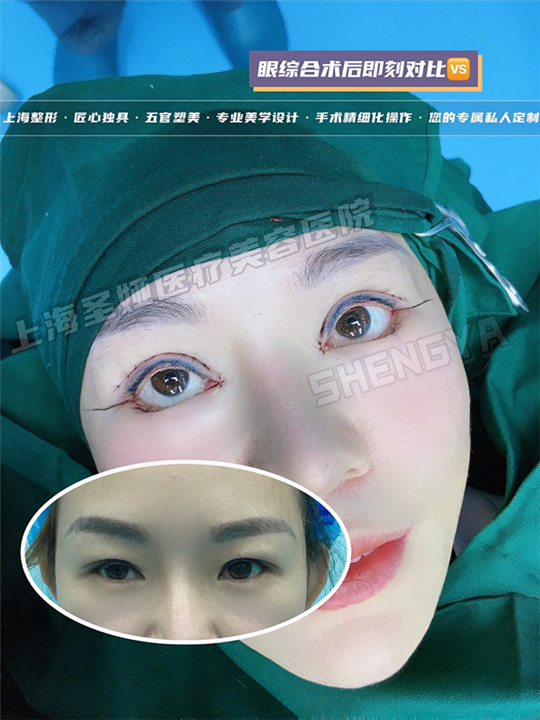 上海做眼综合整形哪家好