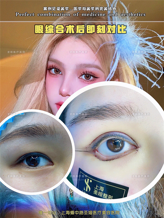 上海圣娅做双眼皮怎么样
