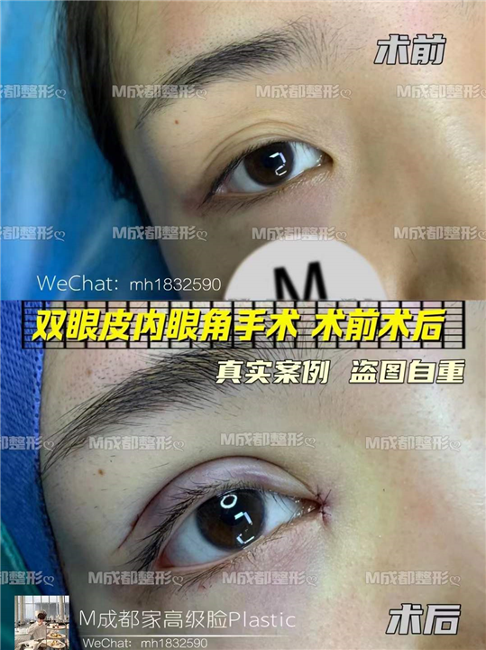 成都眼修复整形医院