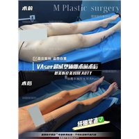 VAser超威塑体雕术前术后对比