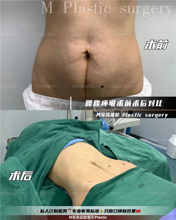 腰腹环吸术前术后对比