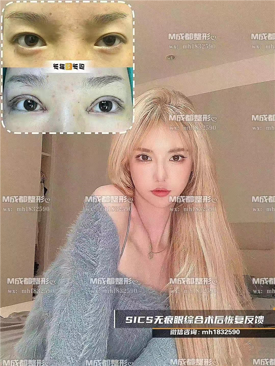 成都无痕眼综合